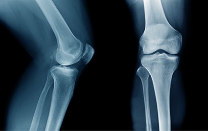 Non-Surgical Treatments for Chronic Knee Injuries and Conditions Bellingham, WA